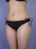 Liposuction Before and after photo