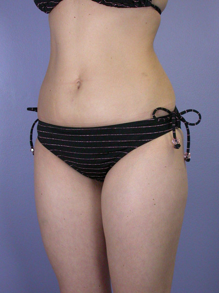 Liposuction before and after photo