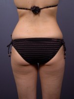Liposuction Before and after photo