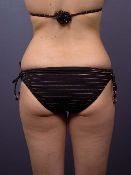 Liposuction before and after photo