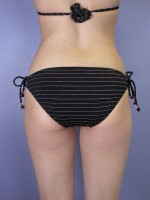 Liposuction Before and after photo
