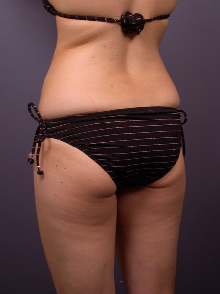 Liposuction before and after photo