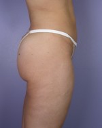 Liposuction Before and after photo