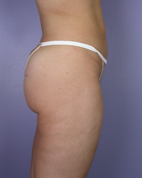 Liposuction before and after photo