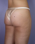 Liposuction Before and after photo