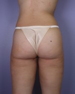 Liposuction Before and after photo