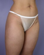 Liposuction Before and after photo