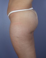 Liposuction Before and after photo