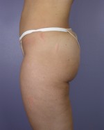 Liposuction Before and after photo