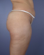 Liposuction Before and after photo