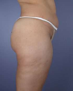 Liposuction before and after photo