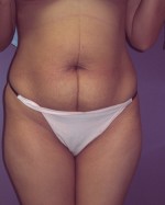 Liposuction Before and after photo