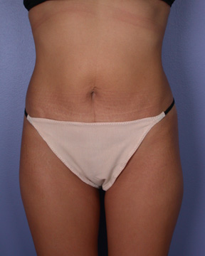 Liposuction before and after photo