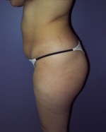 Liposuction Before and after photo