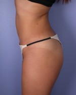 Liposuction Before and after photo