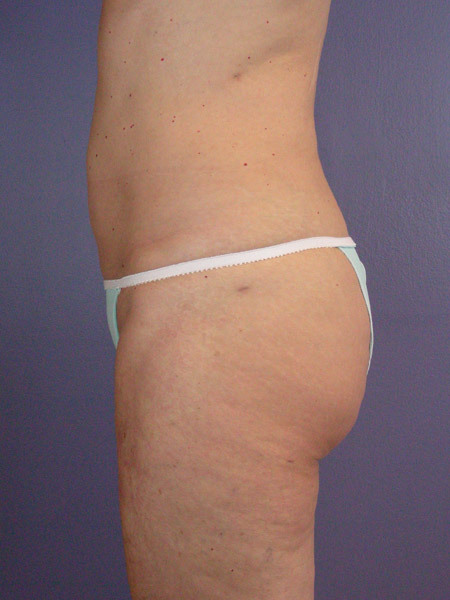 Liposuction before and after photo