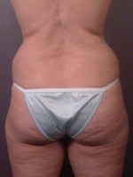Liposuction Before and after photo