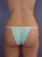 Liposuction Before and after photo