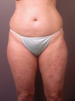 Liposuction