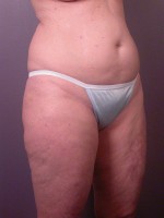 Liposuction