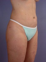 Liposuction