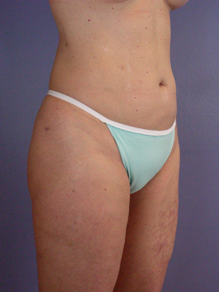 Liposuction before and after photo