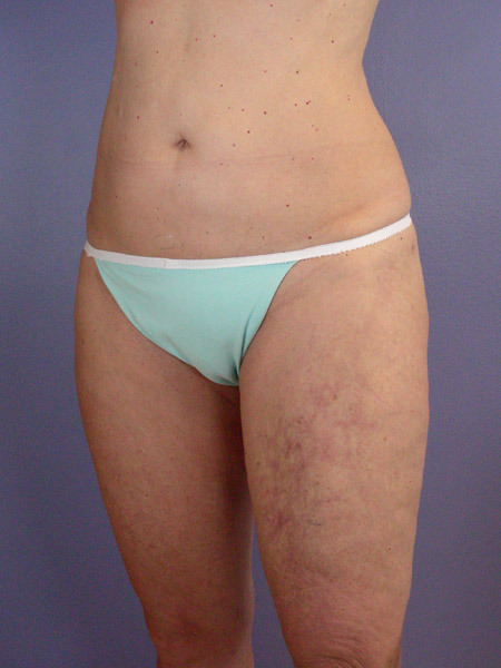 Liposuction before and after photo