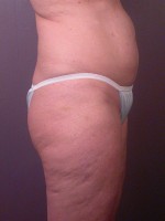 Liposuction Before and after photo