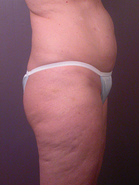 Liposuction before and after photo
