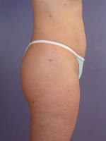Liposuction Before and after photo