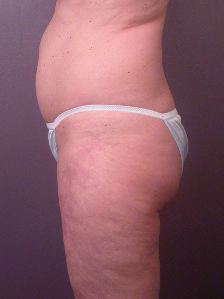 Liposuction before and after photo