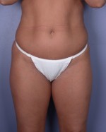 Liposuction Before and after photo