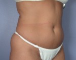 Liposuction Before and after photo