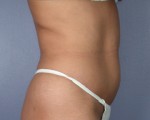 Liposuction Before and after photo