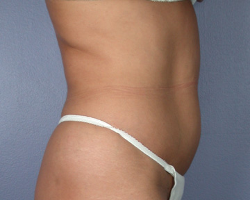 Liposuction before and after photo