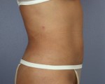 Liposuction Before and after photo