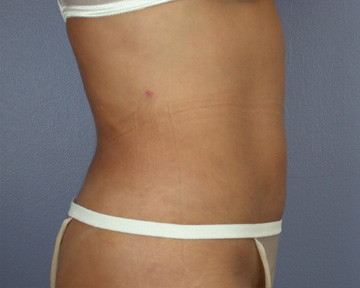 Liposuction before and after photo