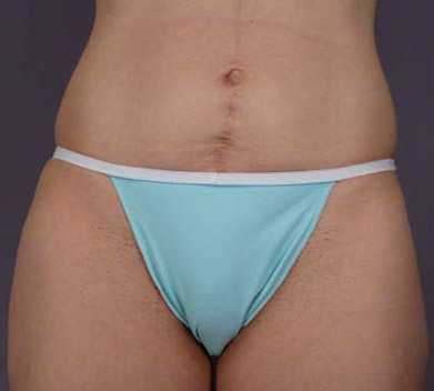 Liposuction before and after photo