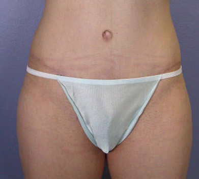 Liposuction before and after photo