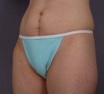 Liposuction Before and after photo