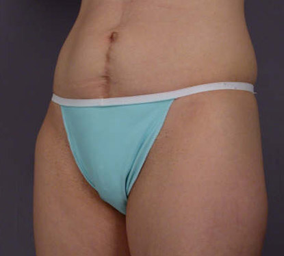 Liposuction before and after photo