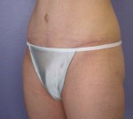 Liposuction Before and after photo