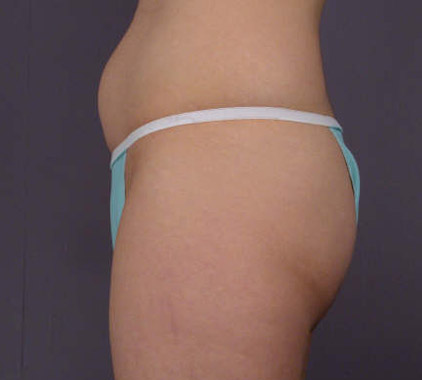 Liposuction before and after photo