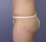 Liposuction Before and after photo