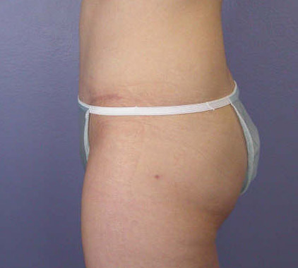 Liposuction before and after photo