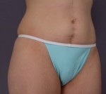 Liposuction Before and after photo