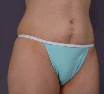 Liposuction before and after photo