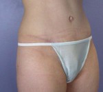 Liposuction Before and after photo