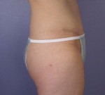 Liposuction Before and after photo