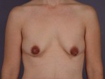 Liposuction Before and after photo